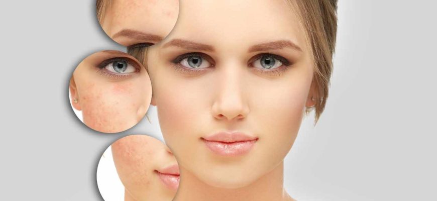 Este é o segredo natural para tratar cicatrizes de acne