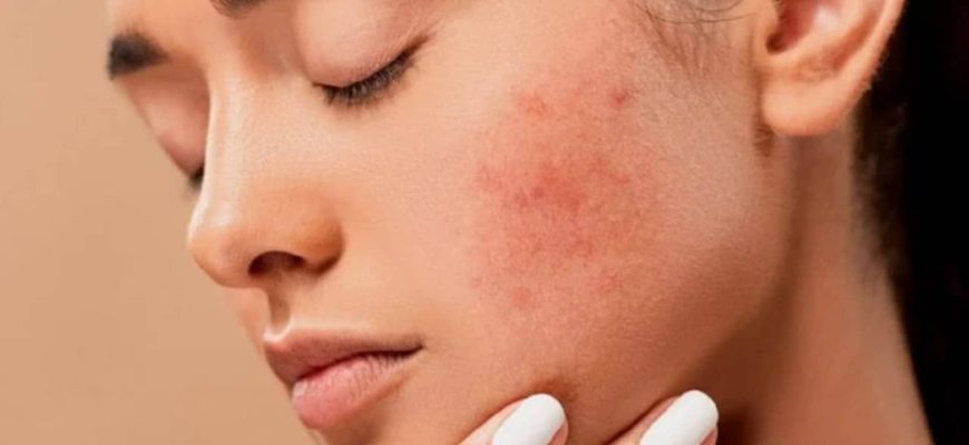 Máscara natural de linhaça para remover as acnes da sua pele