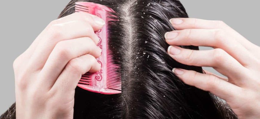 Remédio com 1 ingrediente para eliminar a caspa do seu cabelo!