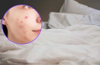 Que tipo de lençol devo usar para reduzir a acne?