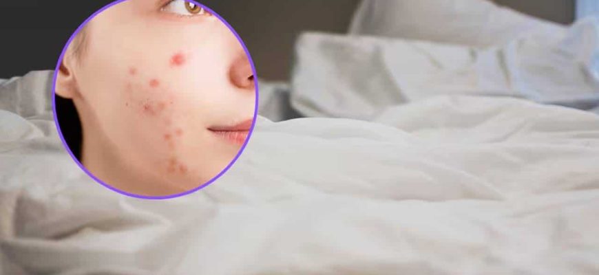 Que tipo de lençol devo usar para reduzir a acne?